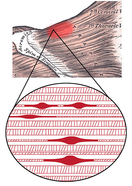 trigger point treatment